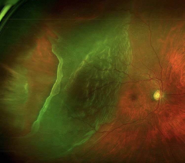 distacco di retina cusumano