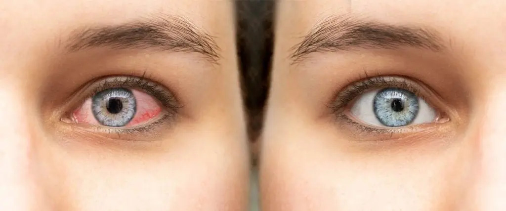 Immagine rappresentativa di occhi rossi